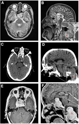 Case report: Concurrent malignant triton tumor and relapsed pituitary adenoma in the sellar region
